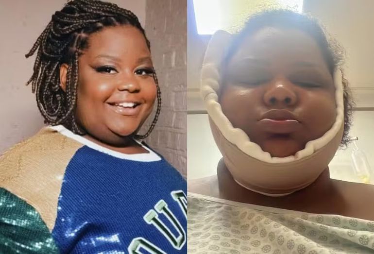 Após perder quase 70 kg, MC Carol passa por lipo de papada e revela nova meta de emagrecimento