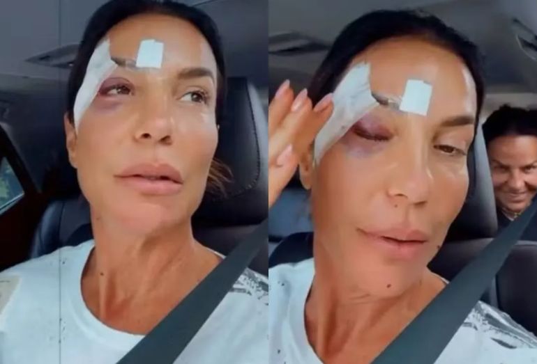 Ivete Sangalo de curativo no rosto, sorrindo dentro de um carro após sair do hospital em Salvador.