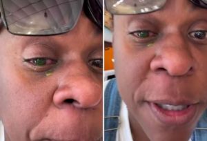 Cacau Protásio relata cegueira temporária e dor intensa após uso de pomada