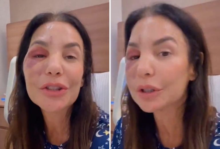 Close no rosto da cantora Ivete Sangalo durante uma transmissão ao vivo, mostrando leve inchaço na região das maçãs do rosto após cirurgia.